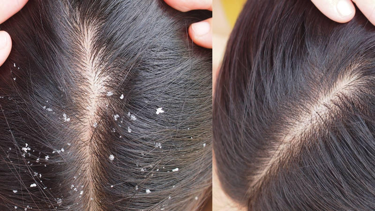 Dandruff care